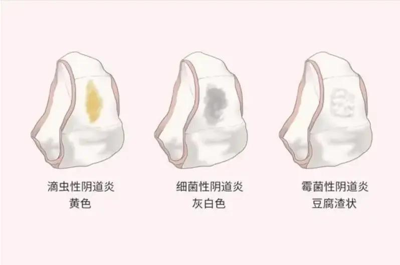 【白带变了黄绿色还有臭味，当心是这种阴道炎！】健康真探社滴虫性阴道炎，一个女性朋