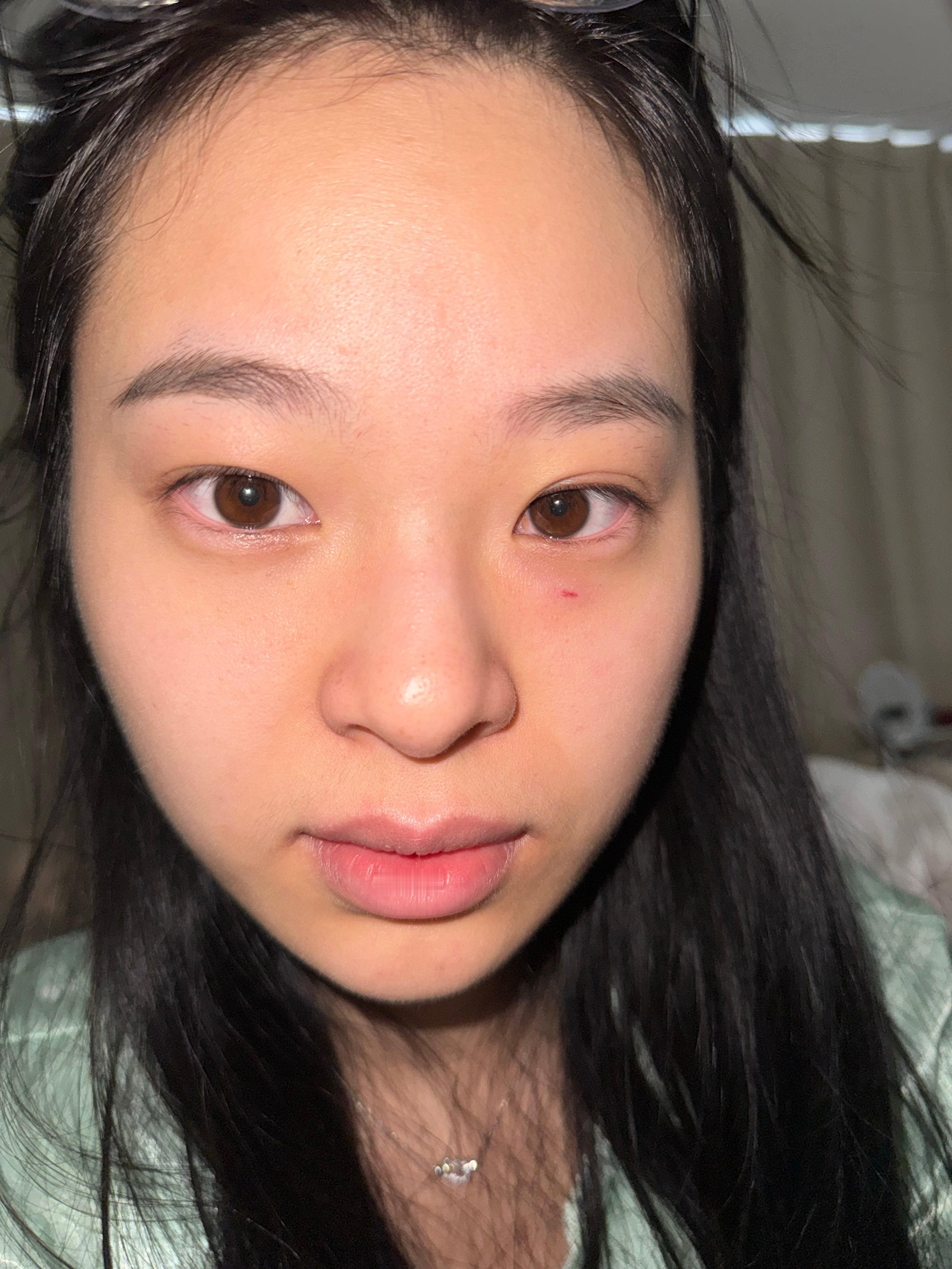 手机掉到眼睛里了…..我痛的一直流眼泪，现在直接肿的卧蚕都没了，凹陷也没了 ​​