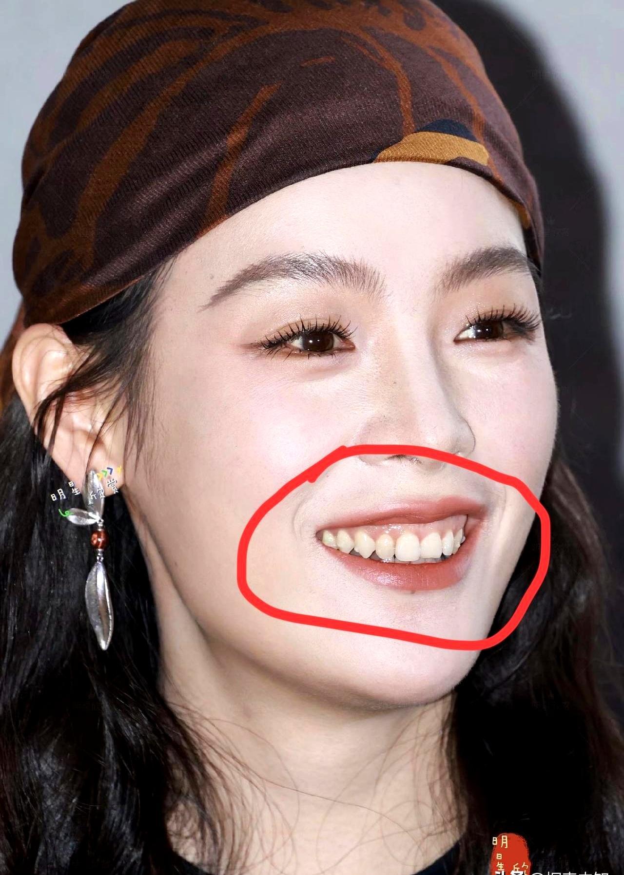 女明星整牙后，反而不敢大笑了。
 
路演现场，高清镜头捕捉到她牙齿上有个细小凸点