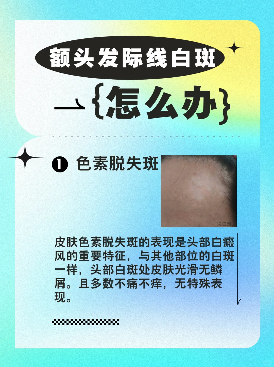 额头发际线处出现白斑怎么办？白癜风要注意