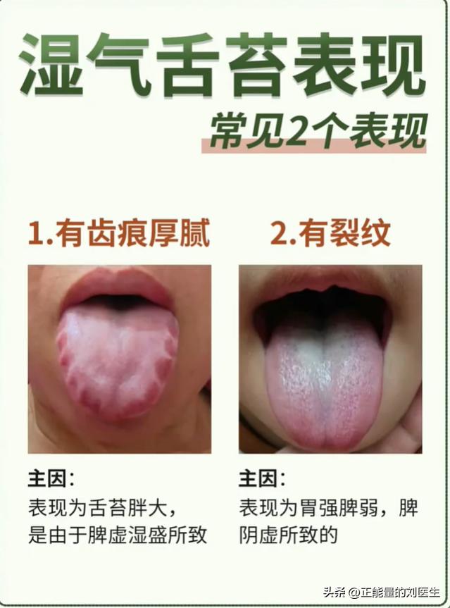 湿气两大舌象：齿痕厚腻和裂纹舌，分清脾虚湿盛与胃强脾弱
