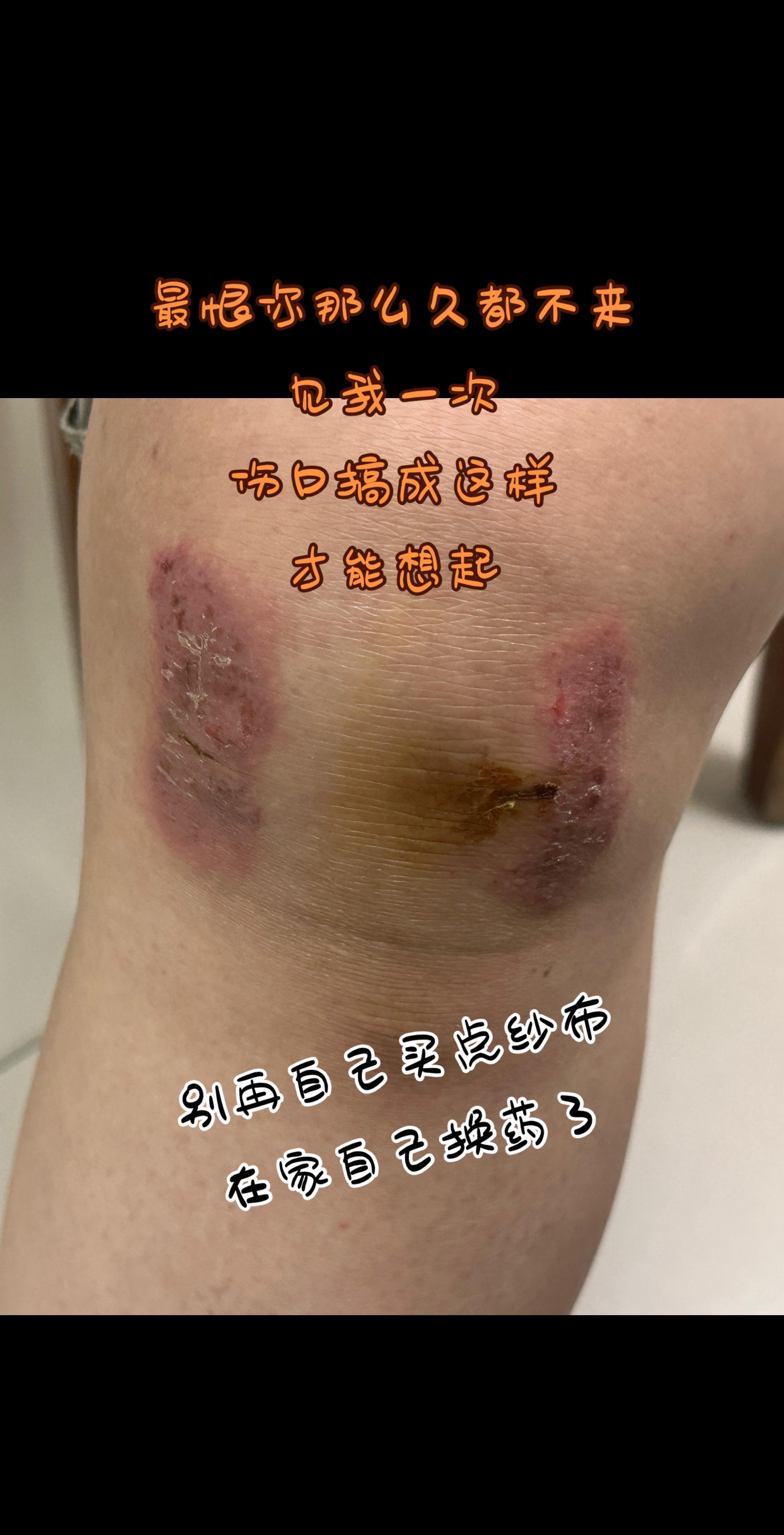 最恨你这样不听话的。伤口搞这样了才肯老实回来复诊