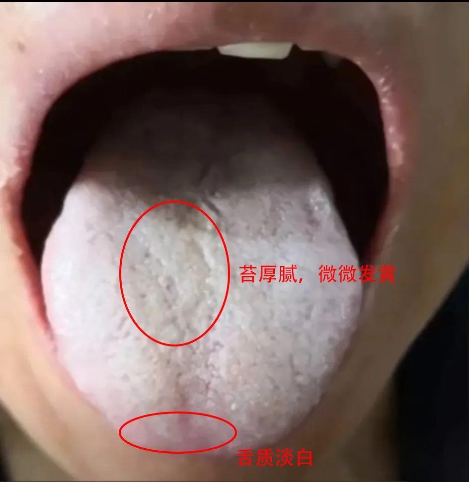 一派虚寒之象，用附子理中芄却效果差是怎么回事？

网诊一三十多岁患者，主诉胃寒，