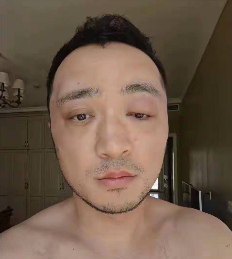 尼格买提在家中，自己染发过敏，导致另一只眼红仲。他还发文，劝粉丝，别自己染发，并