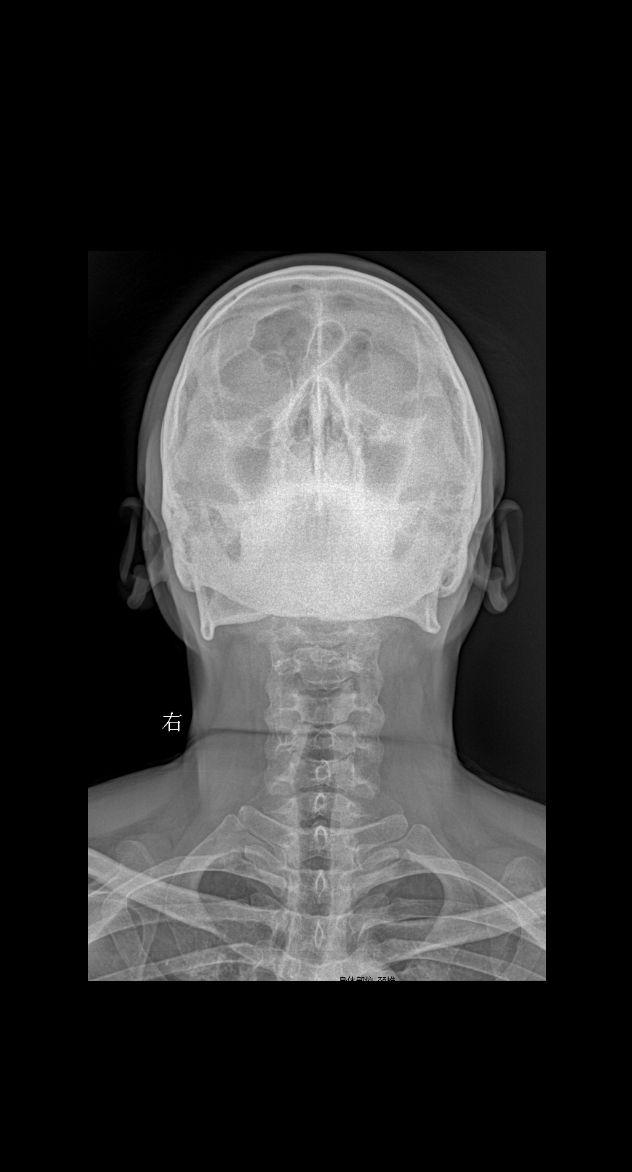 男34 腰椎疼痛 颈椎正侧＋腰椎正侧