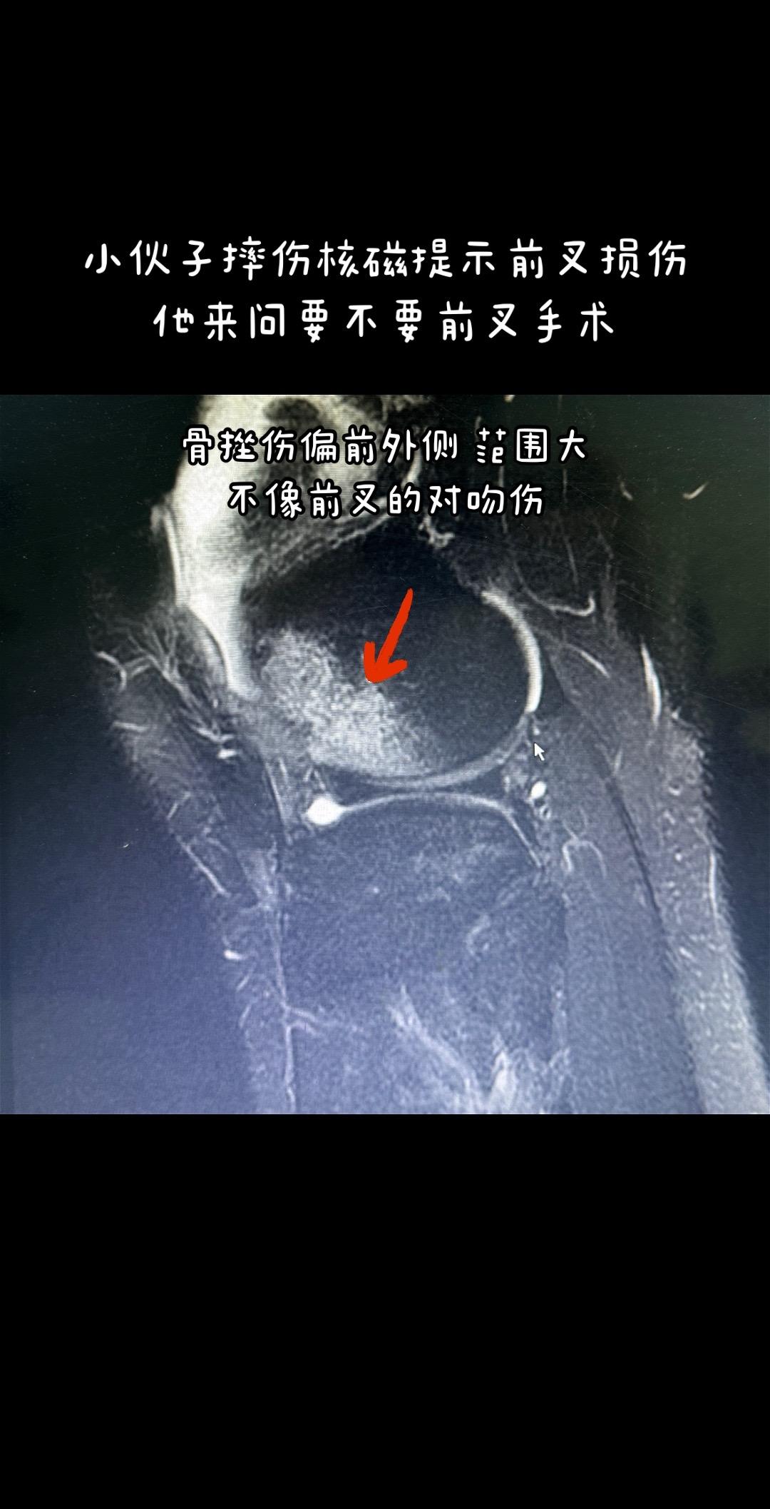 临床上很容易漏掉的问题-髌骨脱位。要注意认真看核磁片和查体，询问受伤史
