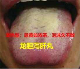 晨起看尿辨健康！3种尿色，对应3种体质，一看就懂！

1. 湿热型：尿黄如浓茶，