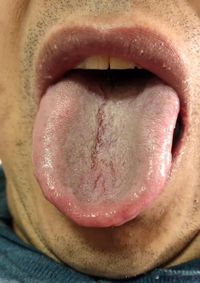 这舌头，像不像一个勺子[what]舌面裂纹贯穿整个舌头[吃瓜群众][吃瓜群众][