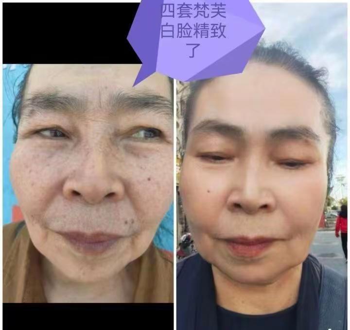 今日头条报道:使用框架核酸四面体，9例患者，7例取得显著疗效；用量仅约为传统蛋白