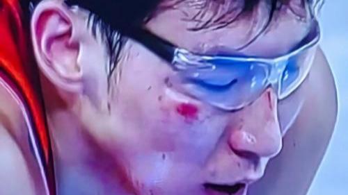 在1月16日晚CBA常规赛北汽男篮与山西男篮一役中，第三节周琦眼睛再度受伤，提前