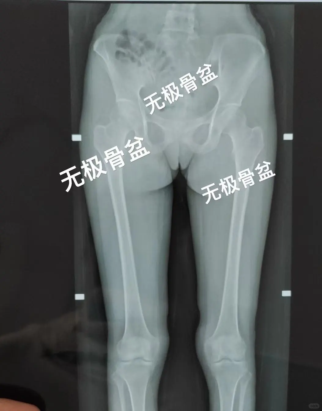 崴脚只是压死骆驼的最后一根稻草