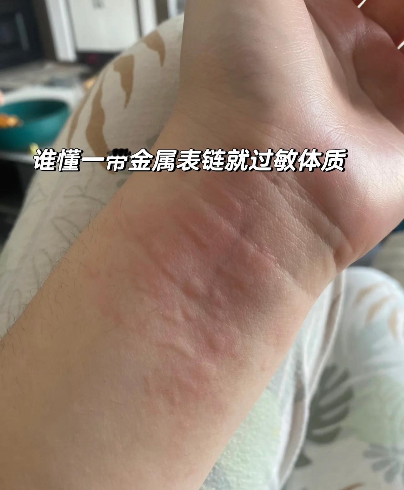 #过敏体质真的有这么离谱吗#谁懂一带金属表链就过敏的体质，妈妈买了个新表，买回家