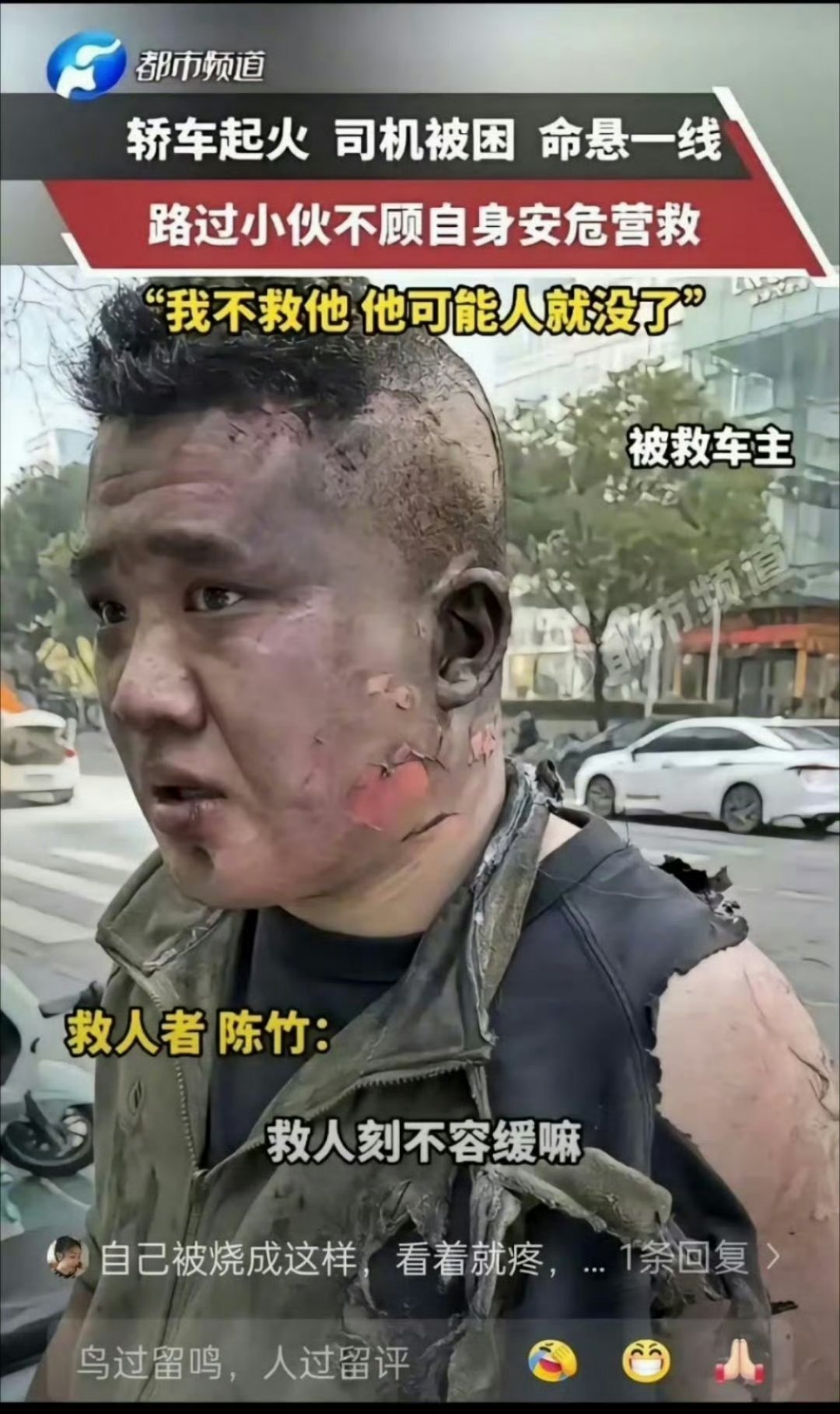 救人英雄自己都烧成这样看着都心疼可能没人记得这位小伙子，但是老天一定会记住他的善