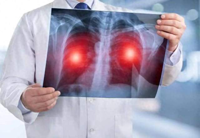 医生提醒：肺癌最危险信号，不是咳嗽，而是频繁出现这5种异常