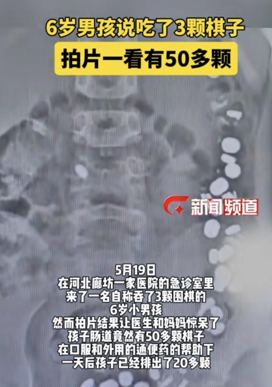 “我吞了三颗棋子！”孩子的一句话瞬间打破平静，河北廊坊家长立刻带娃奔赴急诊，本以