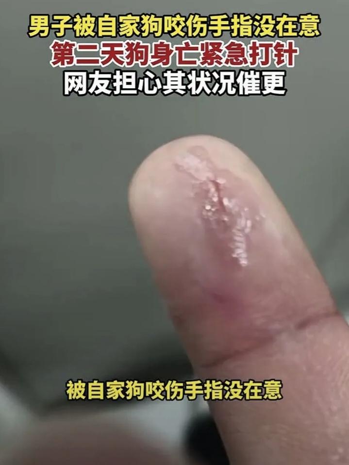 河南一男子被自家狗子咬伤手指后没在意，结果第二天狗子突然身亡，吓得男子赶紧到医院
