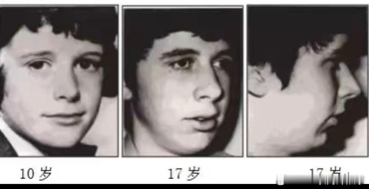 口呼吸 长期口呼吸会形成腺样体面容，如何改善：1.  口周运动法训练口腔肌肉，弹