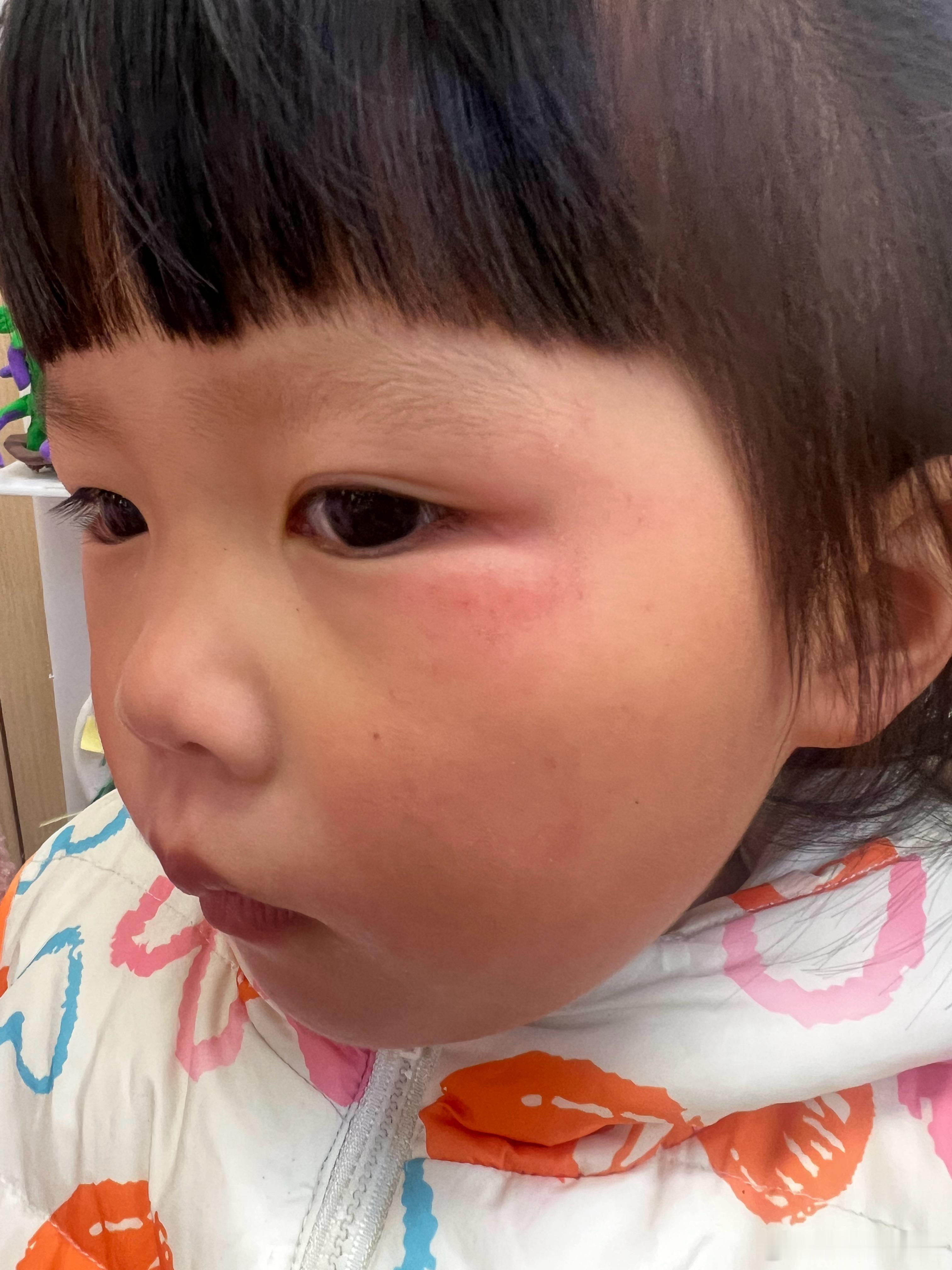 柠宝早上在学校摔了一跤，说在操场上跑步的时候，自己摔的，早上老师发给我看的时候，