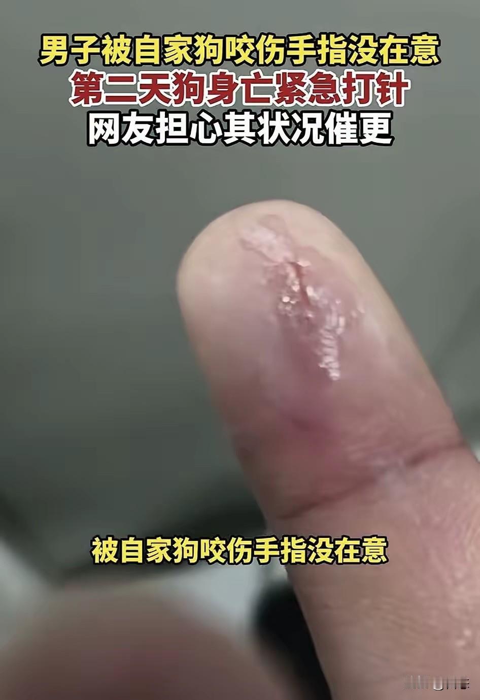 太吓人了，一男子被自家狗咬伤手指，男子没有在意，没想到咬人的狗，居然死掉了。男子