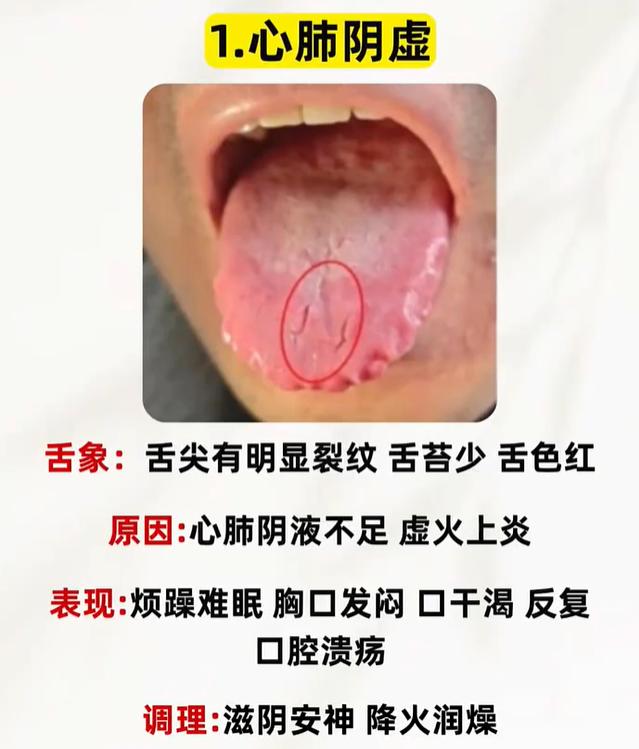 中医舌诊：从舌裂纹长短，分辨三阶段阴虚问题