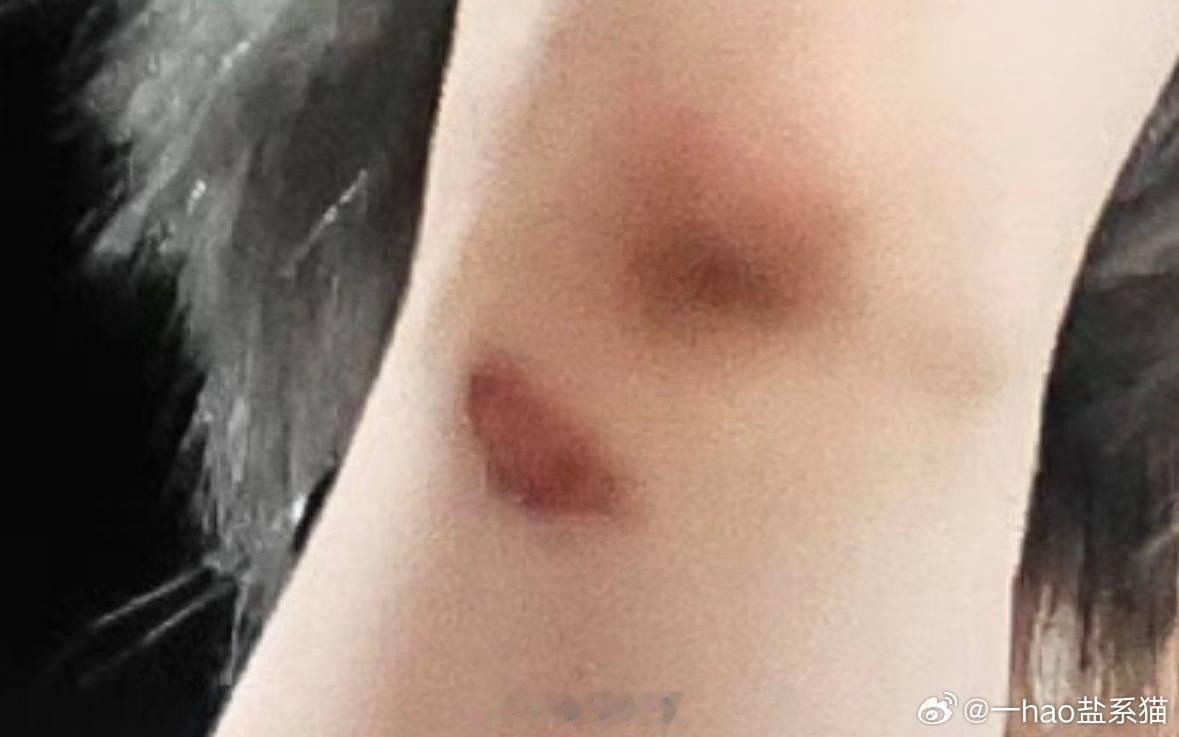 严浩翔手是撞到淤青了严浩翔胳膊淤青严浩翔手是撞到淤青了 