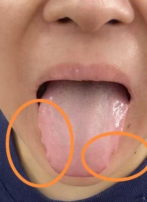 气虚之人最明显的反应是舌周边有齿痕，舌体胖大，舌上唾液多，舌质颜色淡，平时特别累