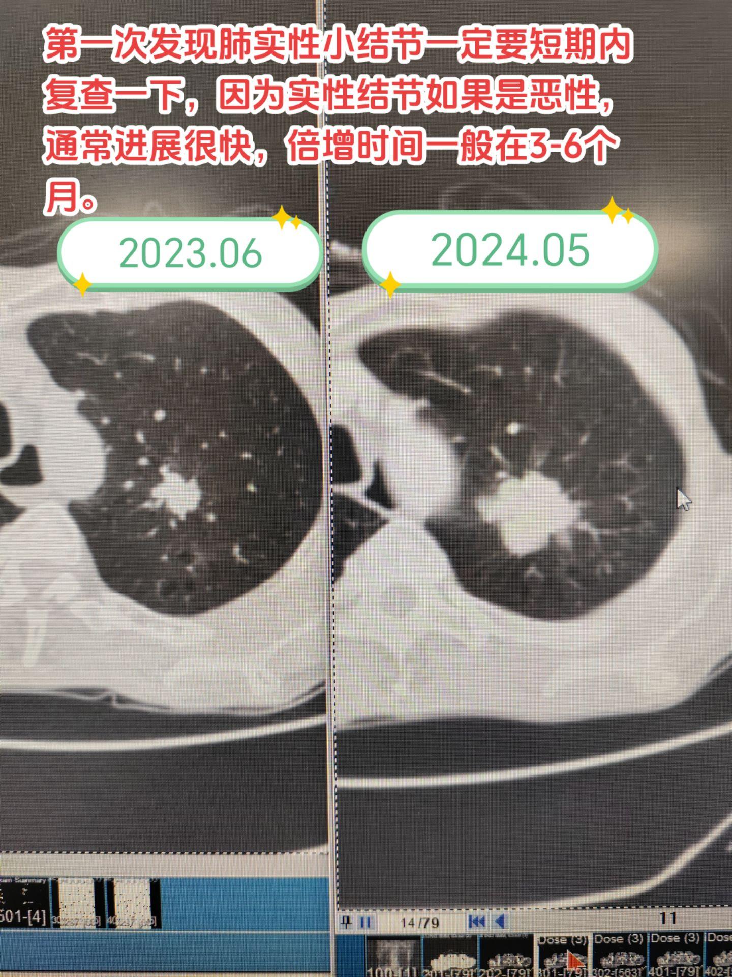 第一次发现肺实性小结节一定要短期内复查一下，因为实性结节如果是恶性，通常进展很快，倍增时间一般在3-6个月。