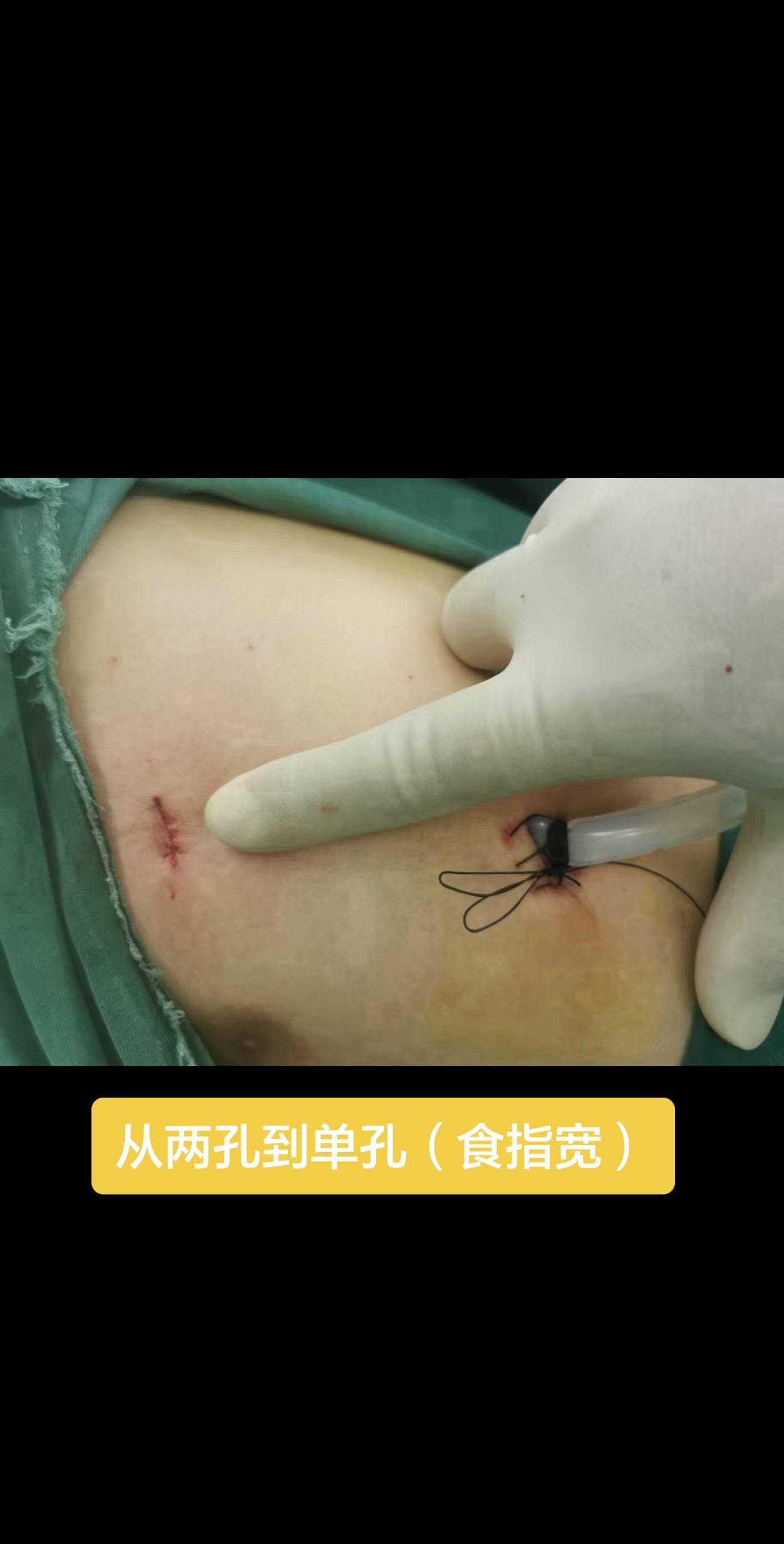 单孔or两孔？ 单孔两孔都是好手术，两种方法都在做，你喜欢哪种方式呢？...