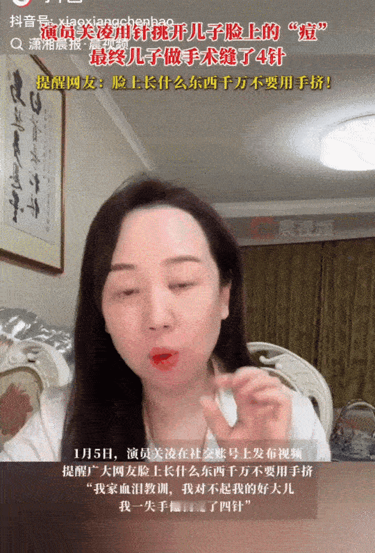 演员关凌登上了热搜，她把儿子脸上的痘痘挑了一针，导致化脓感染，最后缝了四针。去年