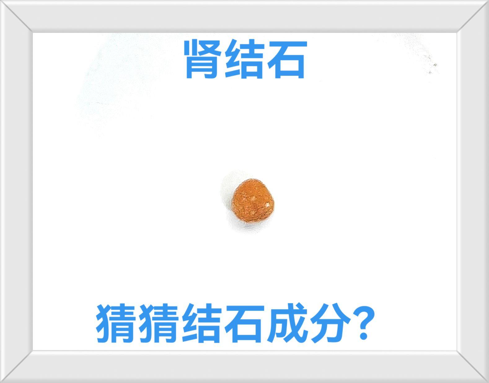 尿酸结石。