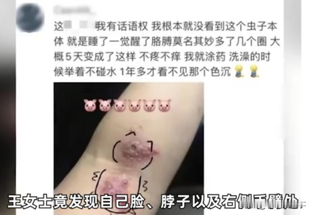 “差点就毁容了”！浙江绍兴，一女子晚上熟睡时，突然觉得脸上痒痒的，以为是蚊子，就
