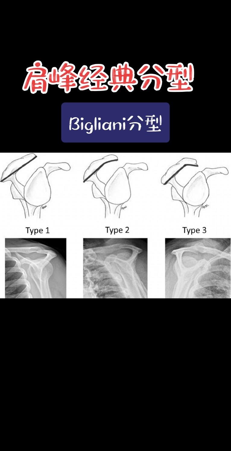 肩峰形态分型。Bigliani分型是用于描述肩峰下表面形态的经典分型。...