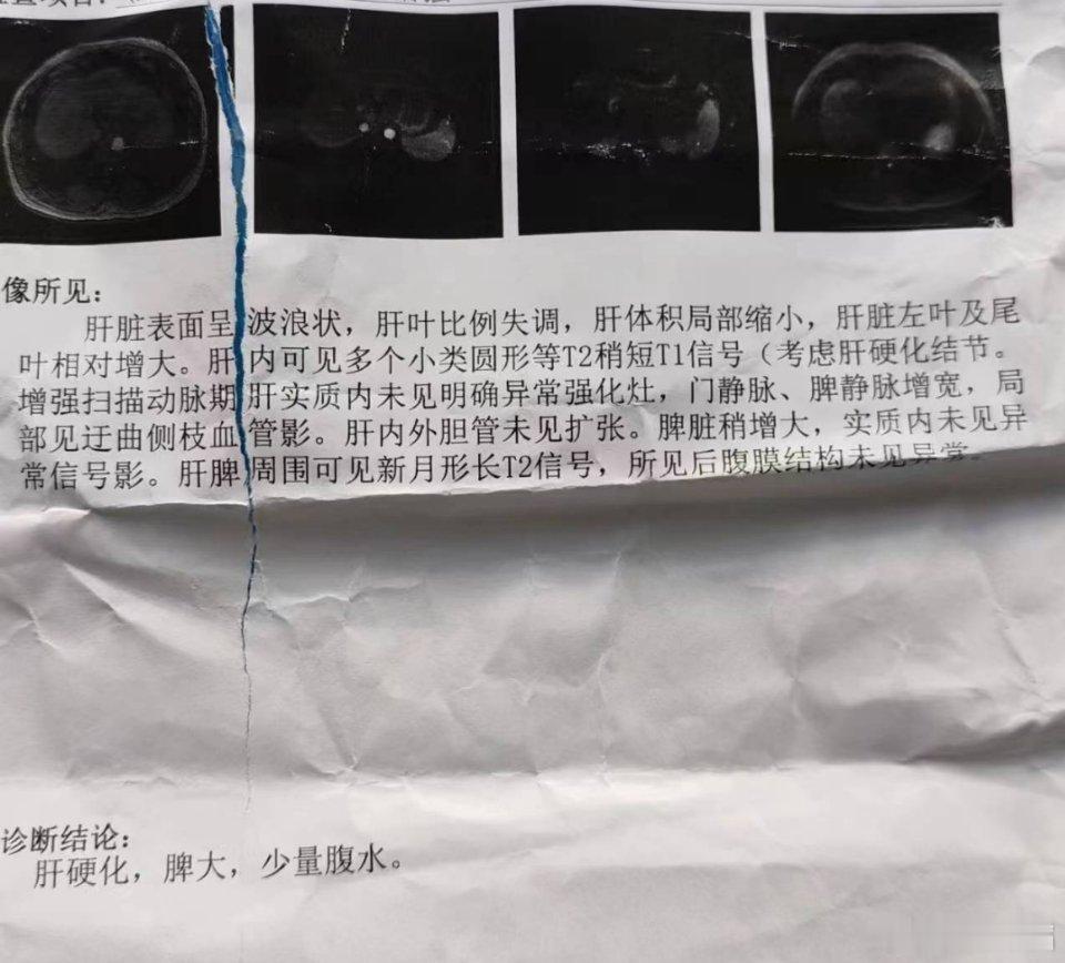 肝硬化后肝纤四项会异常，但是，没法通过肝纤四项反过来诊断肝硬化，诊断肝硬化，目前