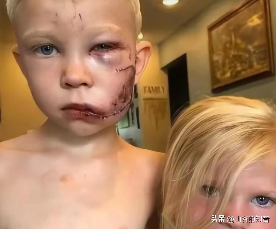 2020年，美国一小男孩从一只牧羊犬口中救出了小妹妹，因此缝了90针，但把他三岁