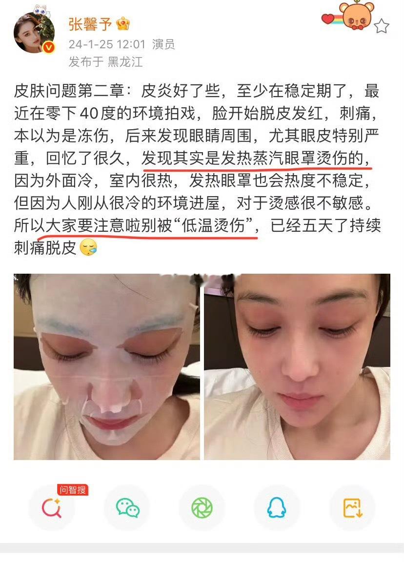 张馨予也被蒸汽眼罩烫伤过暖心共情太戳人了！张馨予暖心评论杨幂，坦言自己也曾被蒸汽
