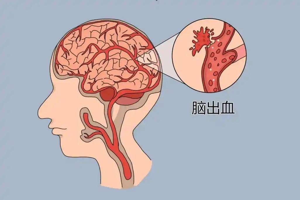 60岁男子因脑出血死亡，医生:天气转热吃降压药，一定要警惕这7点
 
难道天气热
