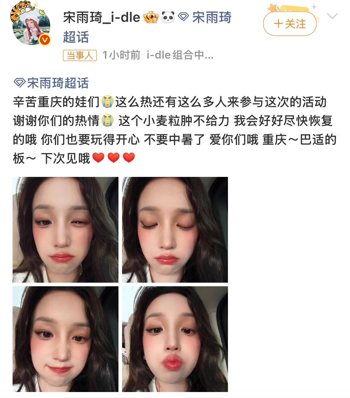 宋雨琦连续高强度活动导致身体疲劳，眼睑腺体发生急性细菌感染，俗称“麦粒肿”。左眼