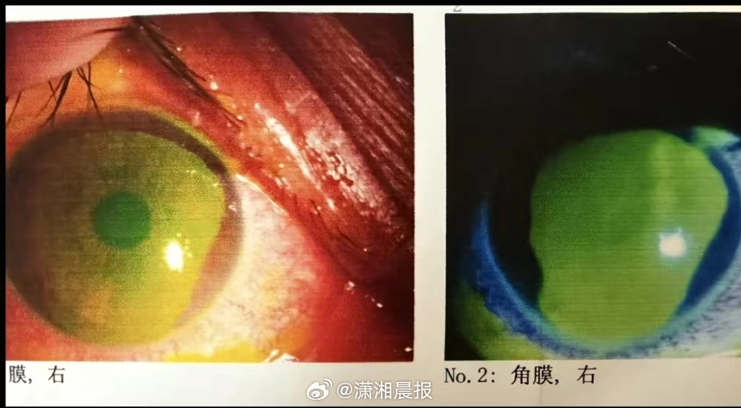 【#女子称沐浴露入眼致眼角膜烧伤#，#品牌方回应沐浴露入眼烧伤眼角膜#：弱酸产品