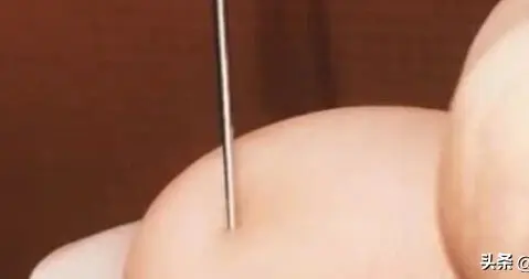 重庆一女子用针取电话卡时用力过猛，针直接扎穿大拇指，当事人：路人看到都在问“怎么做到的”，医生也很震