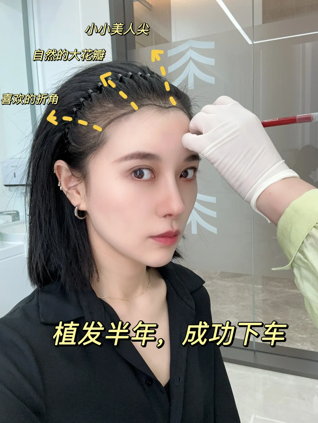 不剃发植发半年｜终于收获妈生发际线