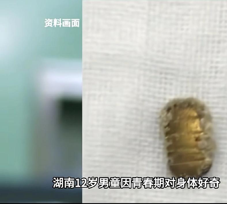 湖南一名12岁男孩因青春期对身体产生强烈好奇，竟将一枚金币塞入尿道，滞留体内两个