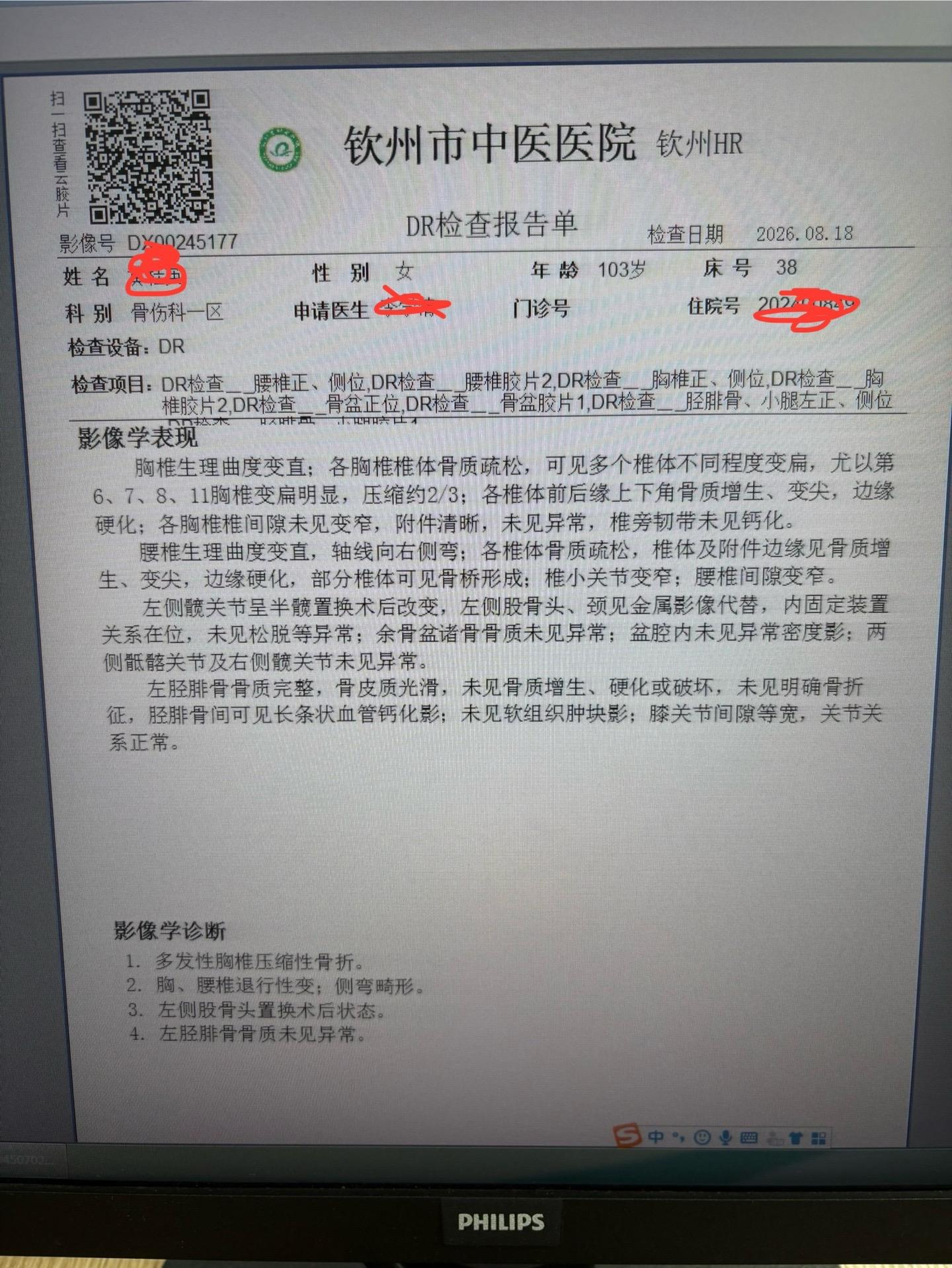一百零一岁时候做的关节置换，两年后复查，老太太精神状态还不错，能自行走...