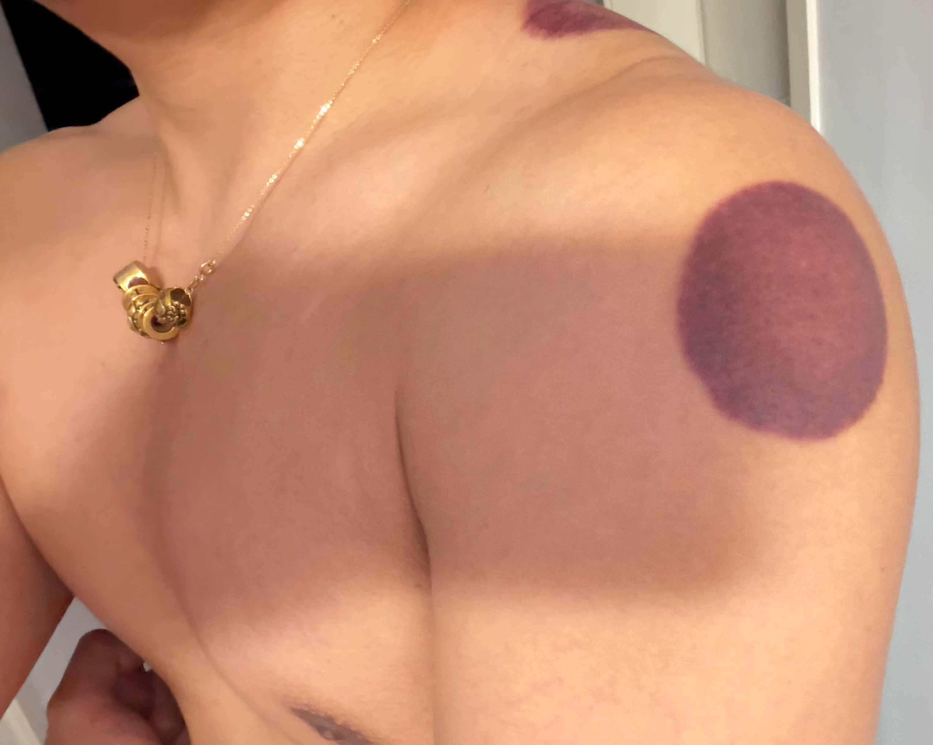 大红大紫？？拔罐完我现在感觉要发烧了…… 