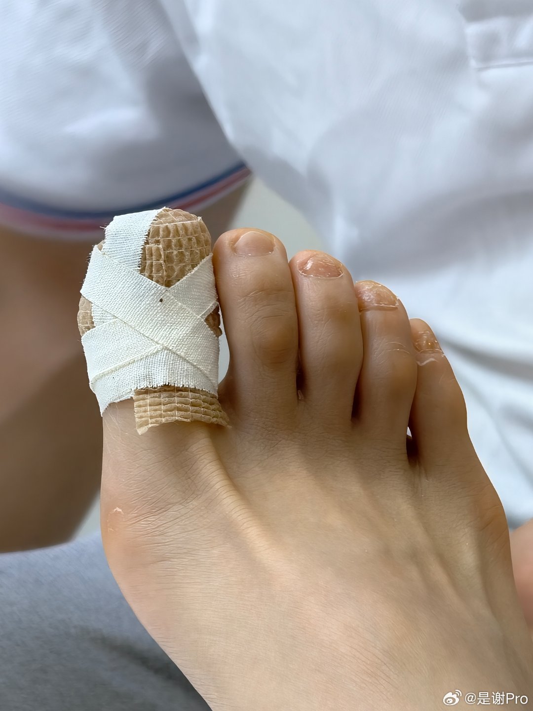 我的脚拇指受伤了  给郑远元修出血了这弱不禁风的身体一点都配不上我钢筋混凝土的心