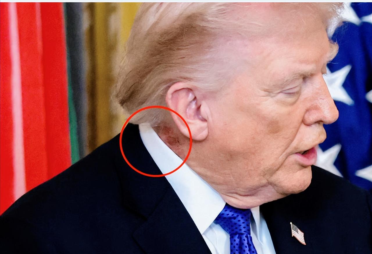 美媒再度炒作！79岁特朗普脖子现红疹，白宫官宣治疗，关键细节却只字不提。
 
7