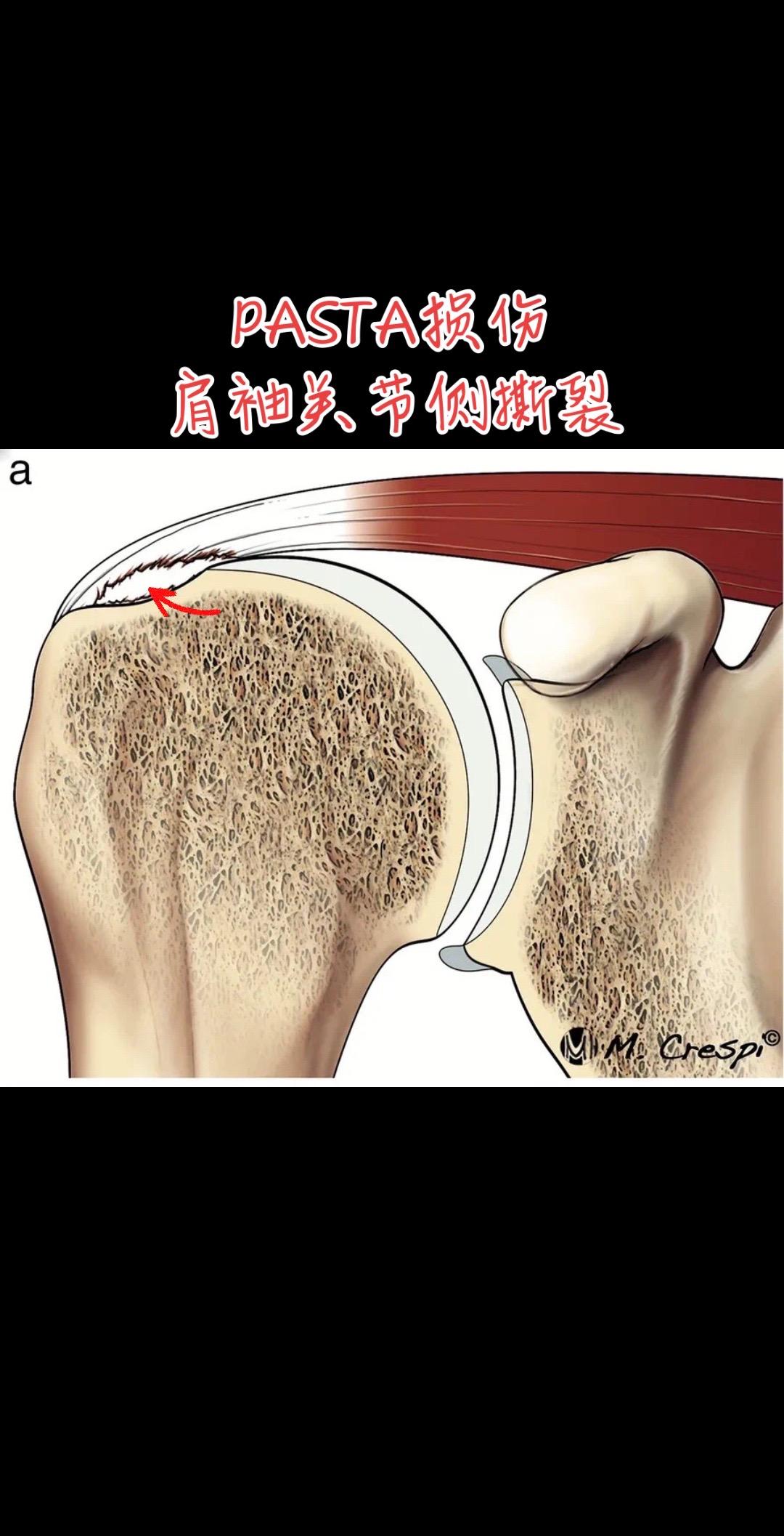 肩袖关节侧撕裂（PASTA 损伤）三图看懂什么是PASTA损伤肩袖部分撕裂
