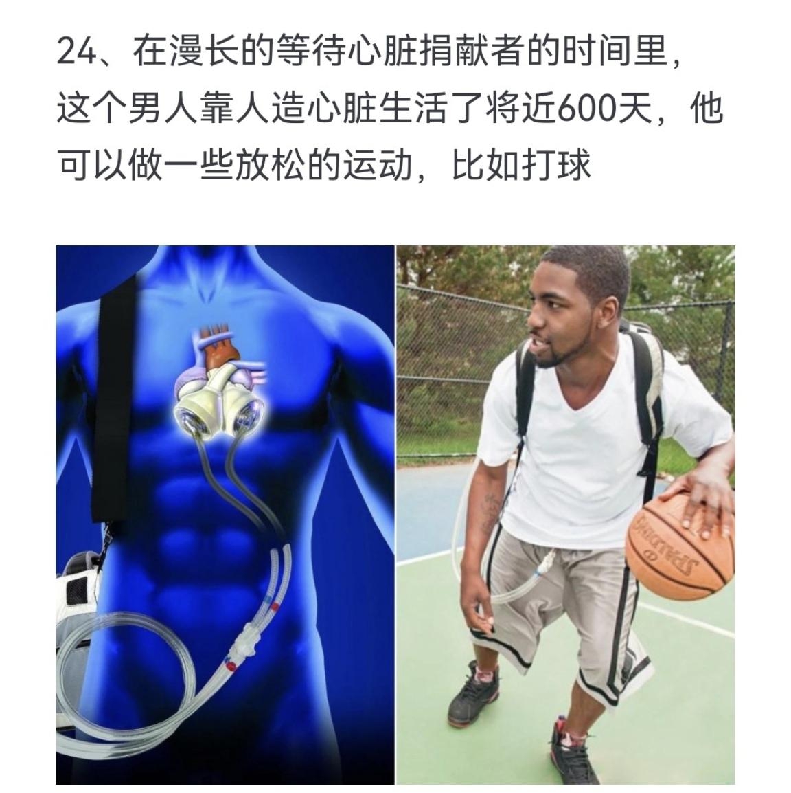 在漫长的等待心脏捐献者的时间里，这个男人靠人造心脏生活了将近600天