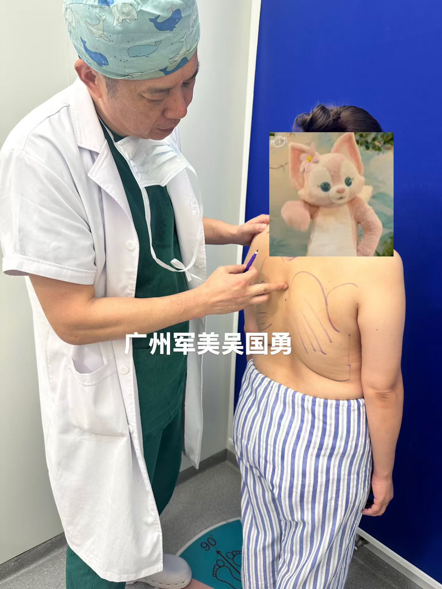 明天端午，朋友圈都在晒粽子，我还在划线。这位求美者主要是腰腹和背部脂肪堆积，上半