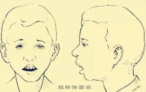 腺样体肥大，这个方子思路可以参考。
腺样体肥大是结果，而不是症状。它表现出的鼻塞
