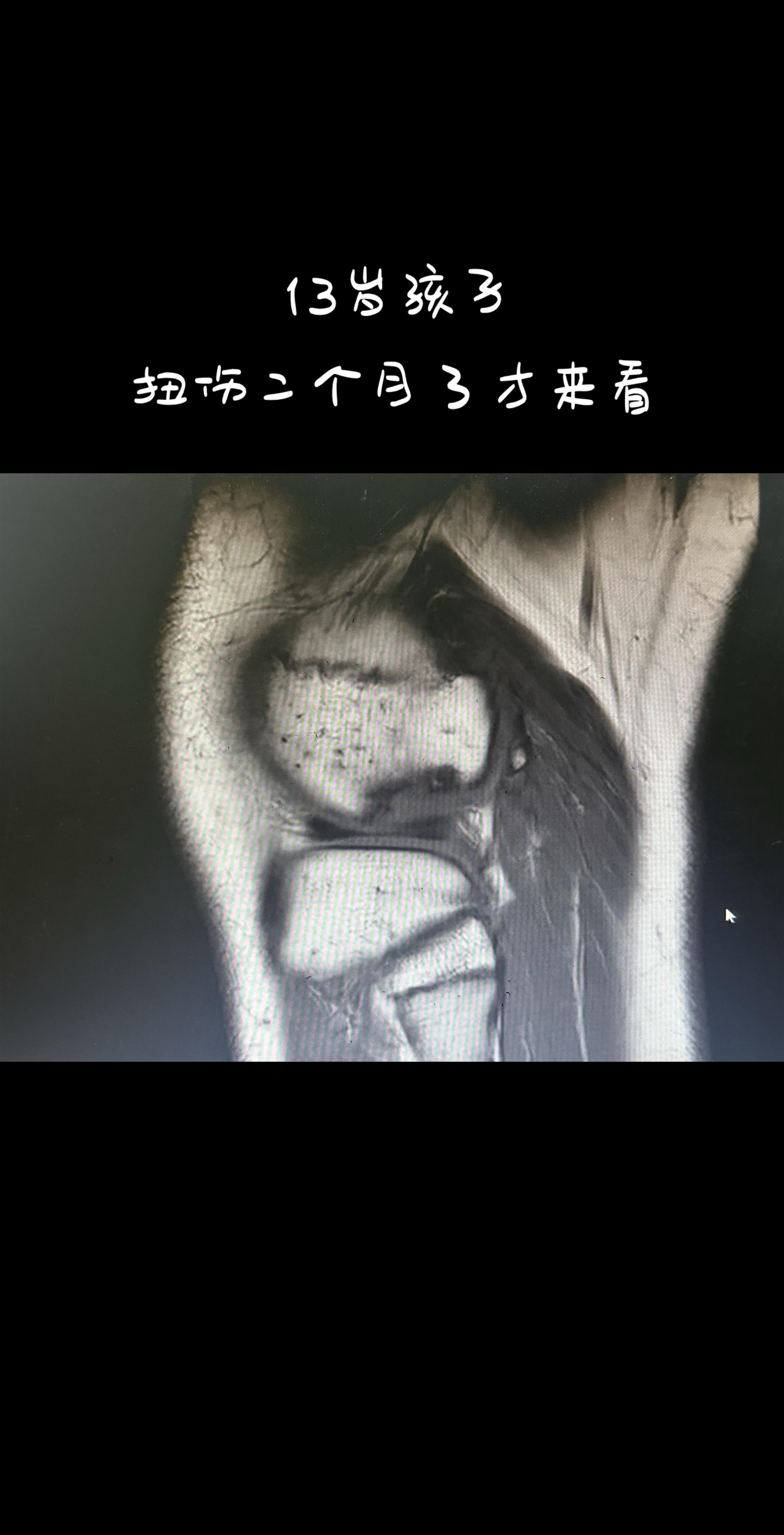 这个孩子扭伤后软骨都坏了。13岁孩子半月板撕裂后磨坏了软骨